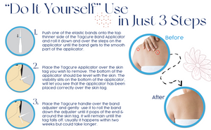 Tagcure - Skin Tag Removal Device