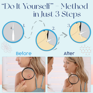 Tagcure - Skin Tag Removal Device