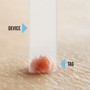 Tagcure - Skin Tag Removal Device